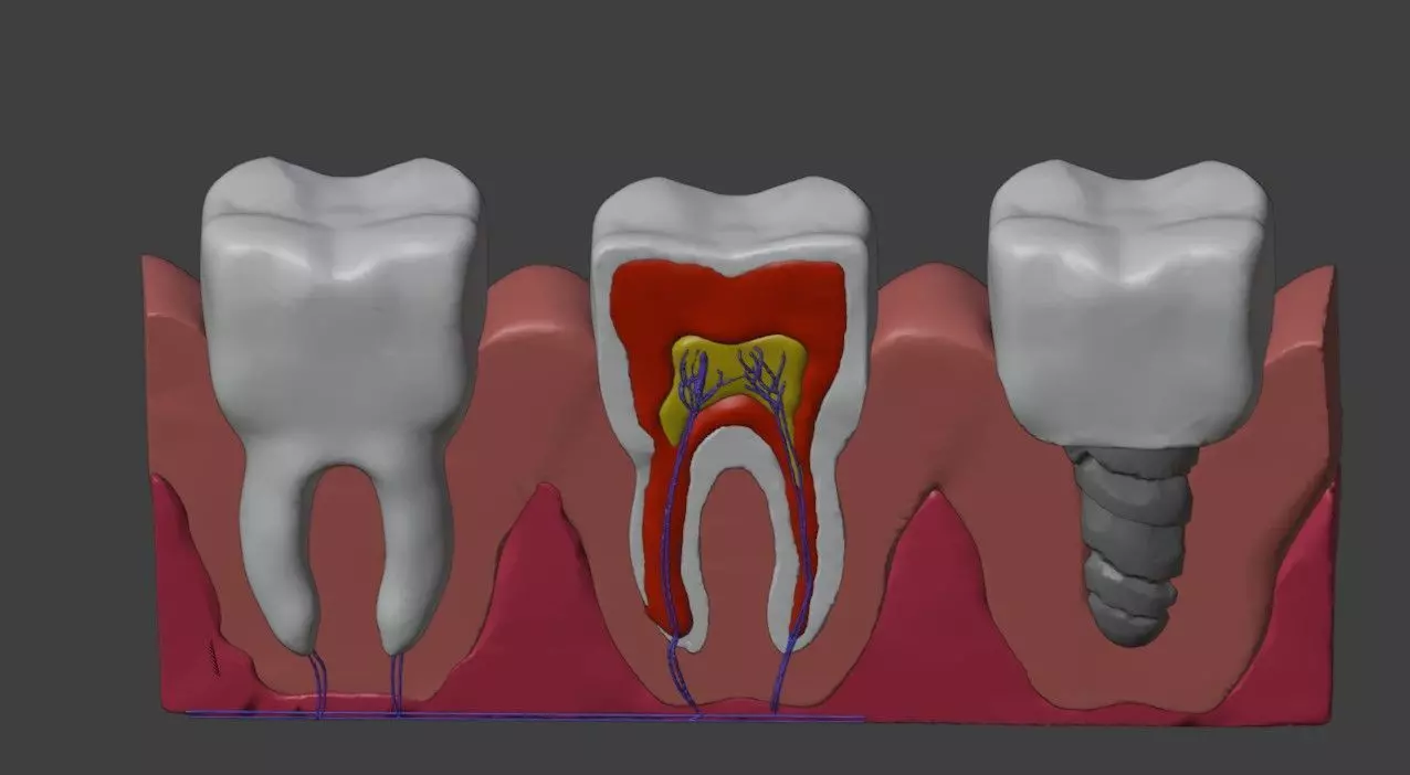 3D Dental Model - Teeth and Gum 3D print model_0