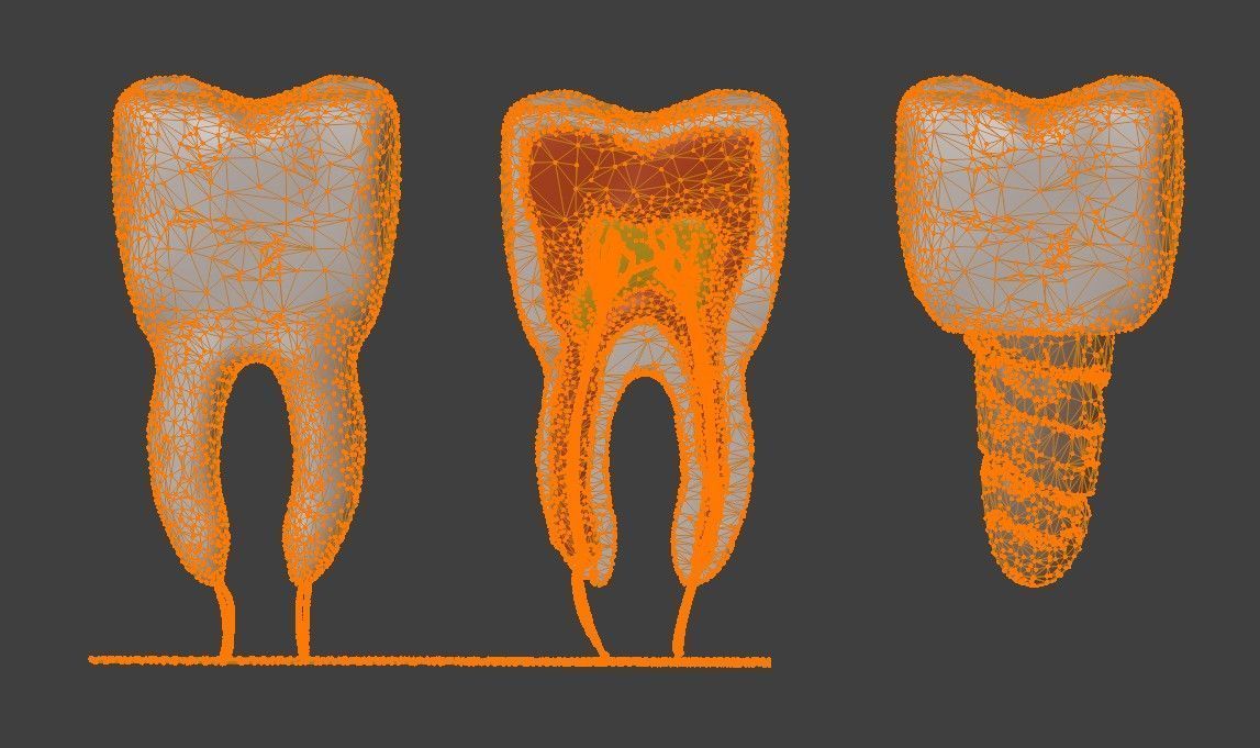 3D Dental Model - Teeth and Gum 3D print model_8