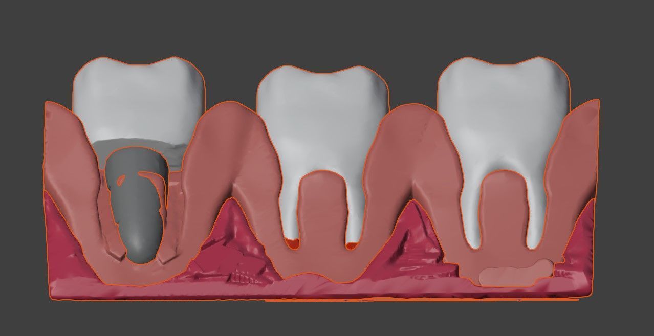 3D Dental Model - Teeth and Gum 3D print model_3