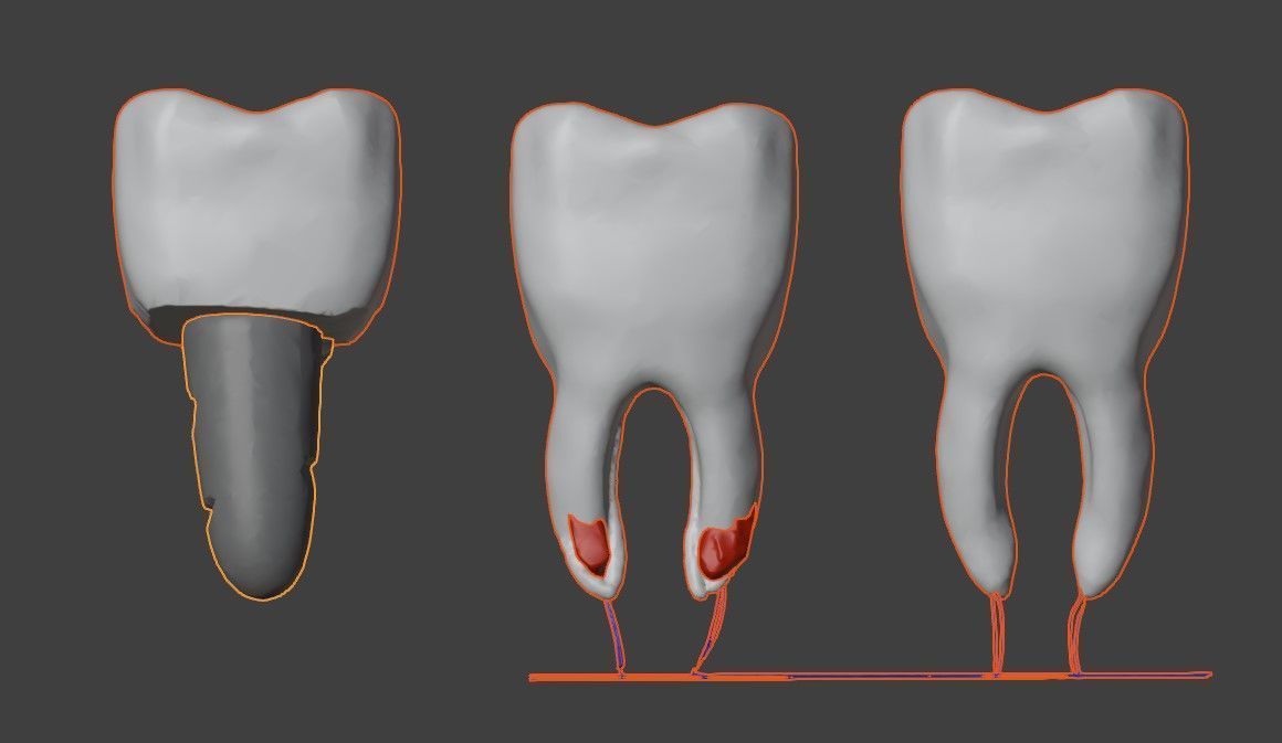 3D Dental Model - Teeth and Gum 3D print model_9
