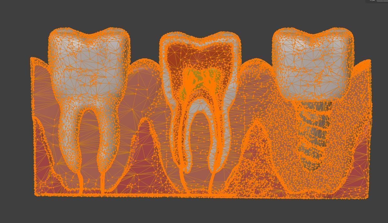 3D Dental Model - Teeth and Gum 3D print model_6