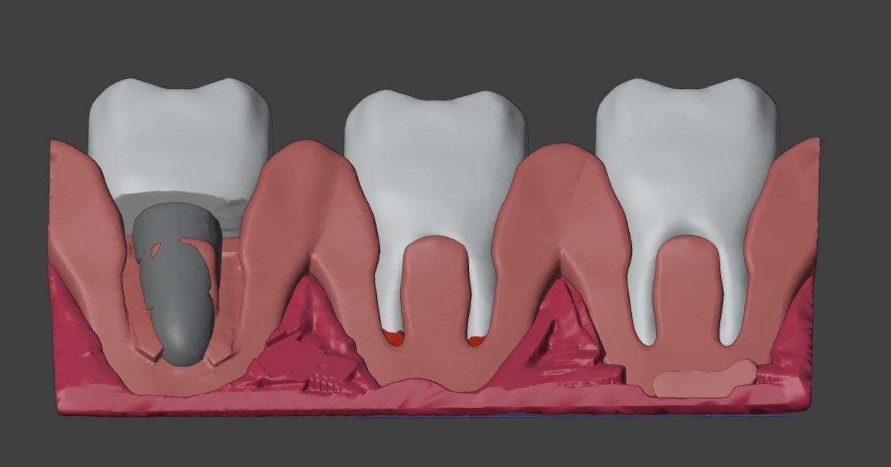 3D Dental Model - Teeth and Gum 3D print model_2