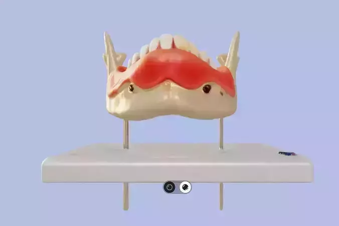 3D Model of Dental Disease - Lower Jaw 3D print model