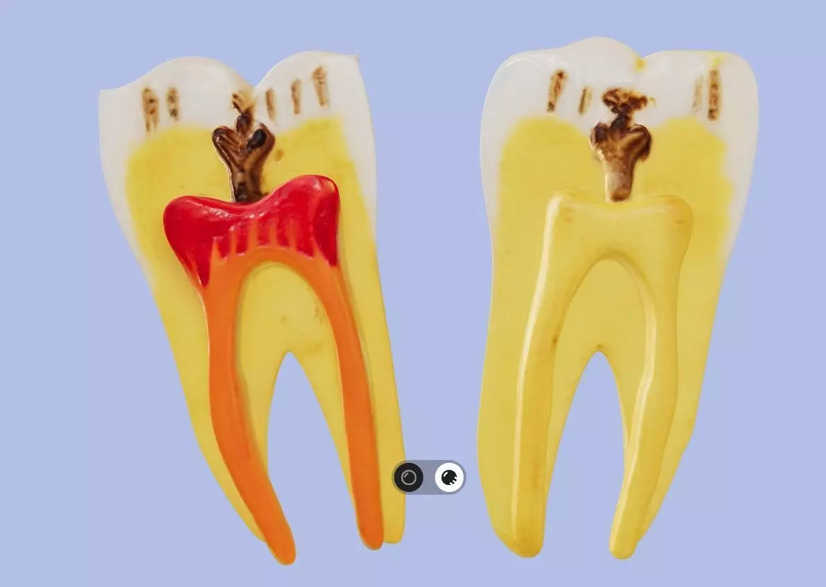 3D Model of Diseased Teeth 3D print model