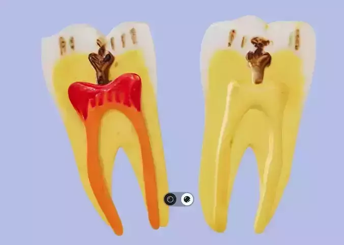 3D Model of Diseased Teeth