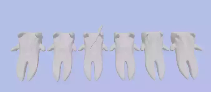 3D Model of Root Canal Therapy - Dental Model 3D print model