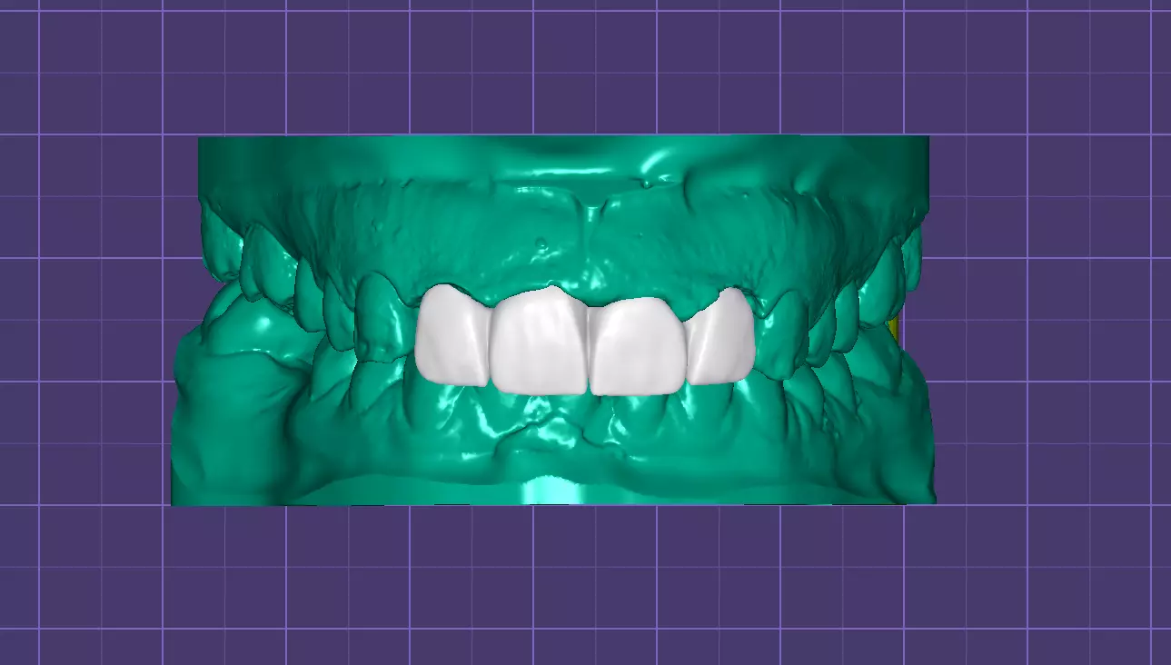 4-Unit Dental Bridge Design Free 3D print model