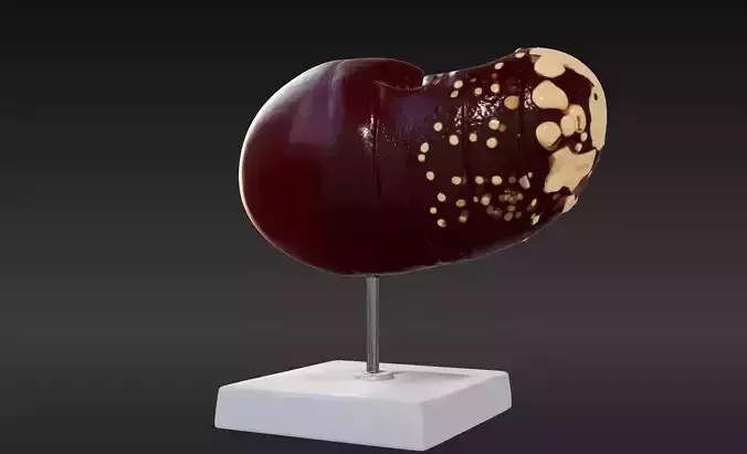 3D Model of Human Liver with the Progression of Liver Disease 3D print model