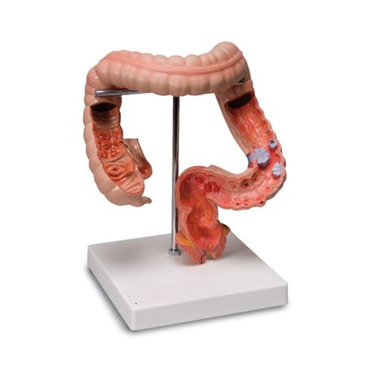  3D Model fo Intestinal Diseases 3D print model_14