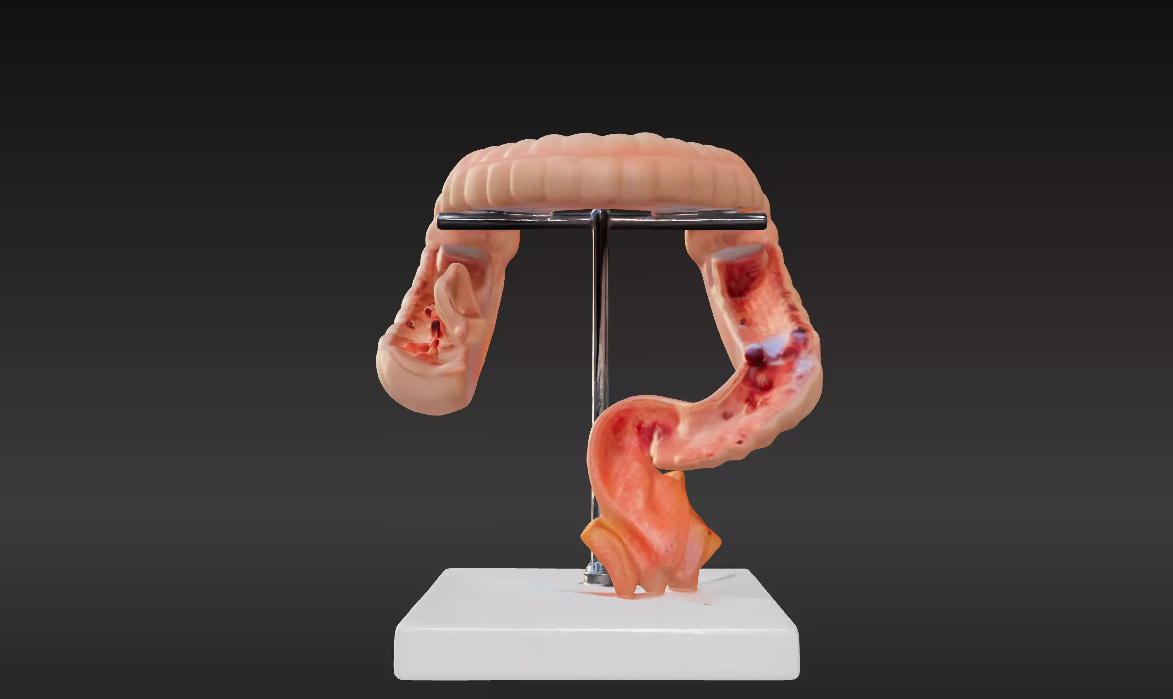  3D Model fo Intestinal Diseases 3D print model_0