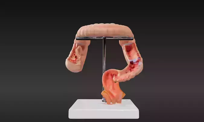  3D Model fo Intestinal Diseases 3D print model