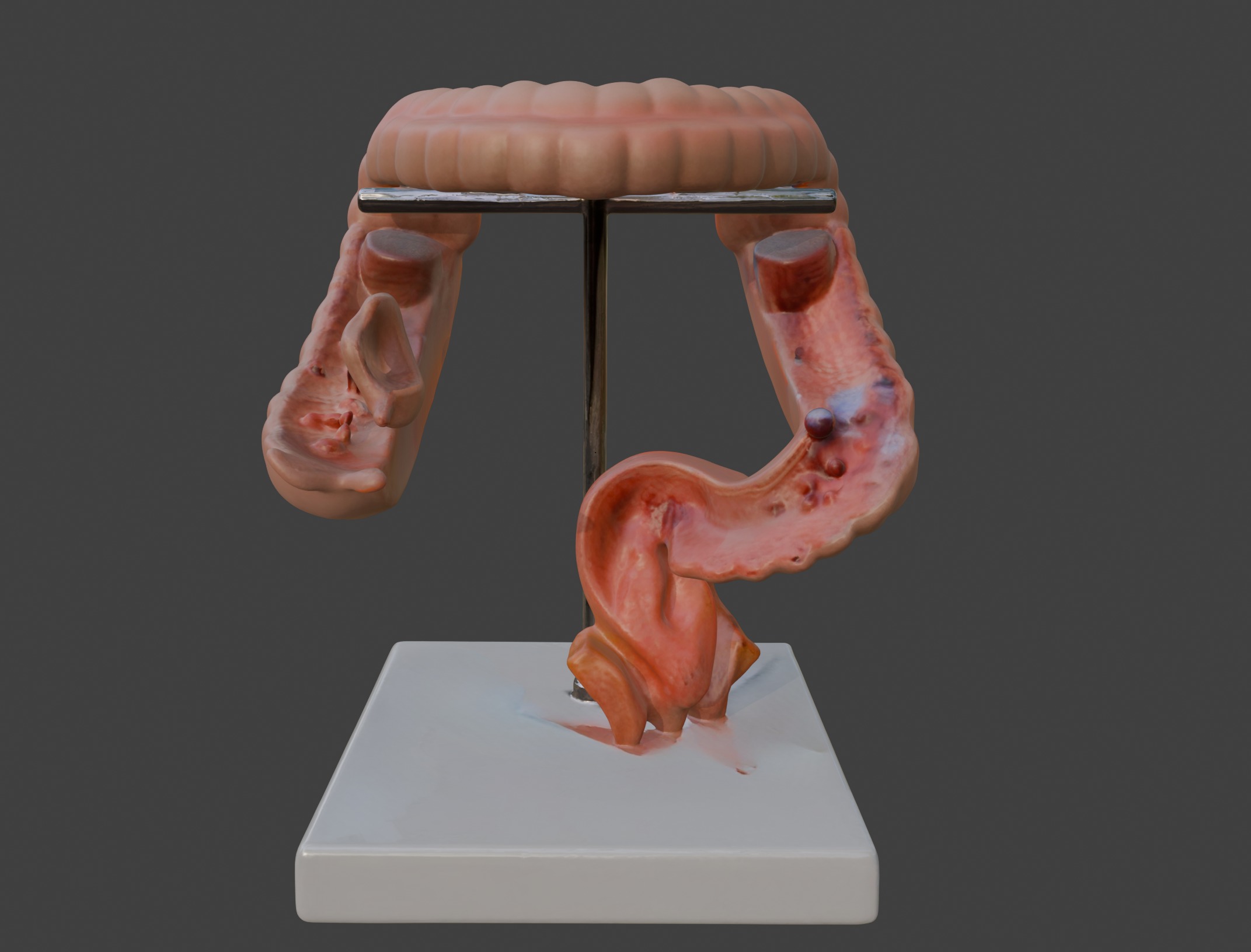  3D Model fo Intestinal Diseases 3D print model_6
