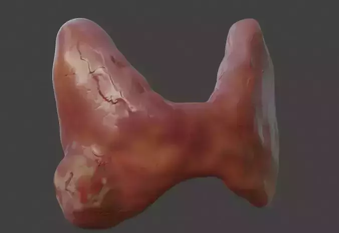 3D Model of Thyroid Gland with Cancer 3D print model