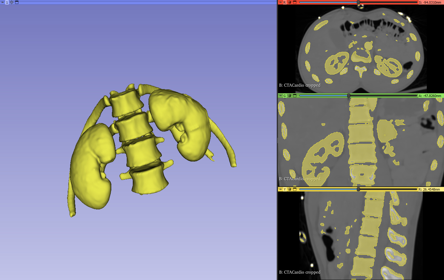 Kidneys and ureters 3D print model_3
