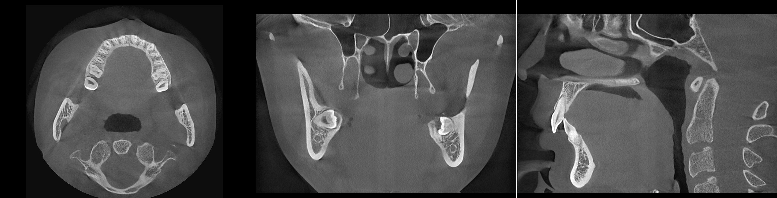 Patient CT-CBCT DICOM Volume Segmentation - STL-OBJ-DCM format 3D print model_1