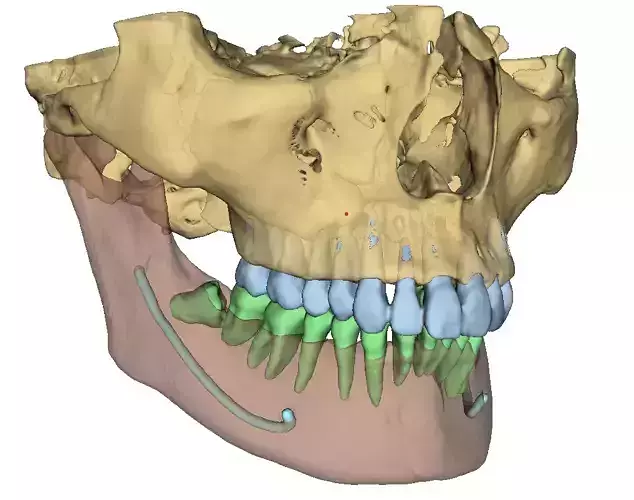 Patient CT-CBCT DICOM Volume Segmentation - STL-OBJ-DCM format