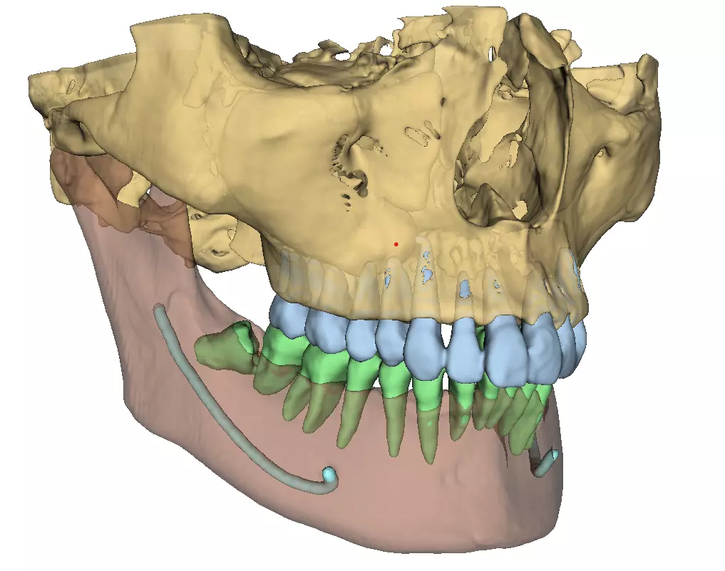Patient CT-CBCT DICOM Volume Segmentation - STL-OBJ-DCM format 3D print model_0