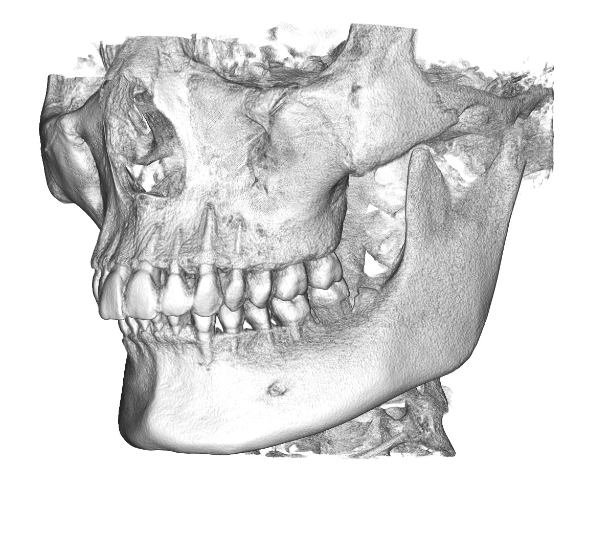 Patient CT-CBCT DICOM Volume Segmentation - STL-OBJ-DCM format 3D print model_2