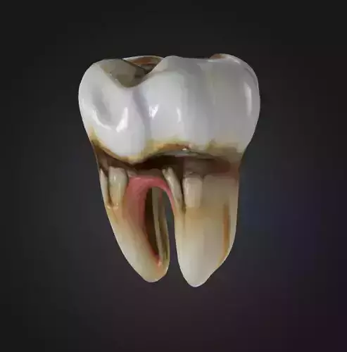 Decayed Tooth