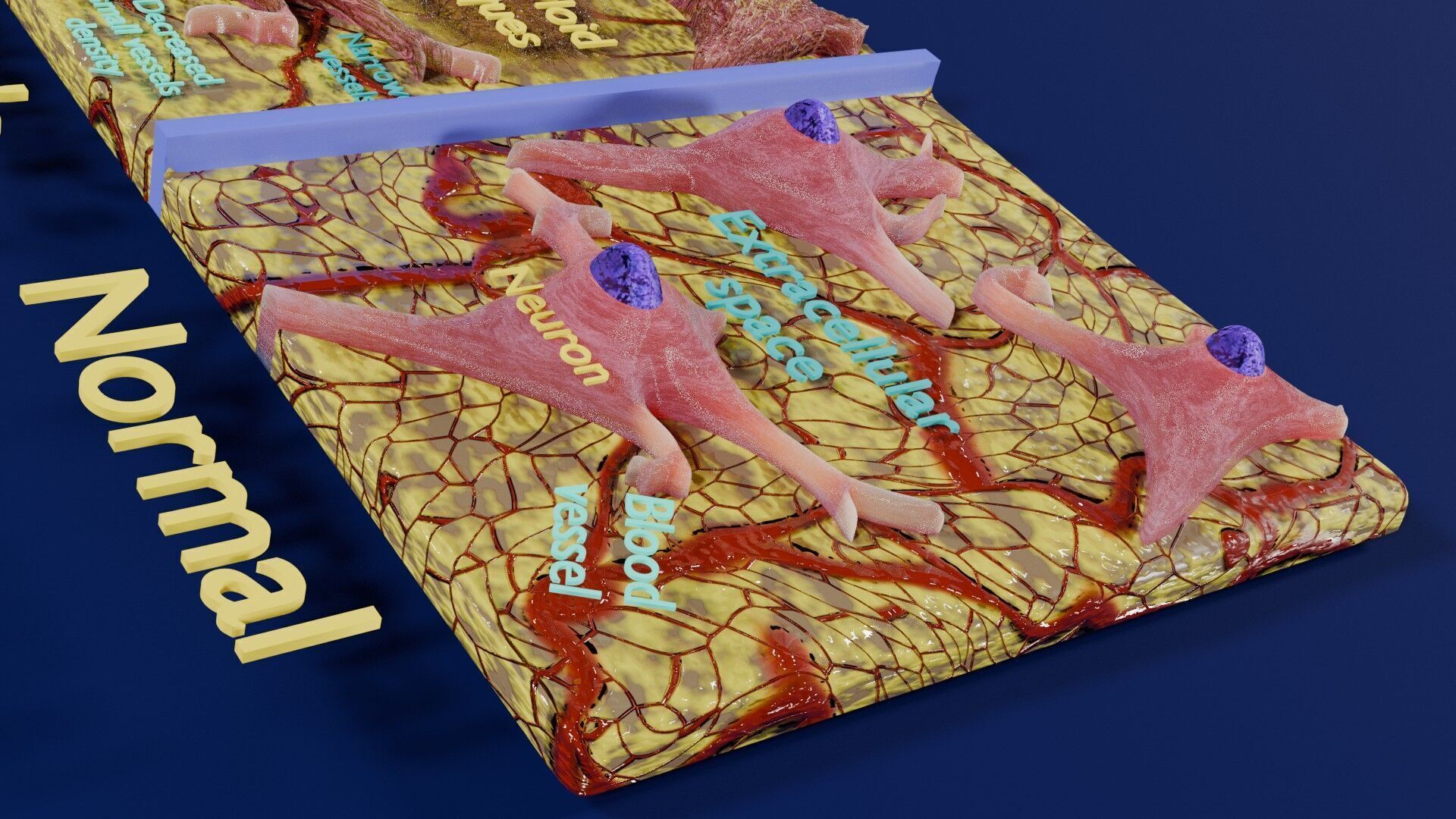 Alzheimer disease microscopy changes brain Low-poly 3D model_4