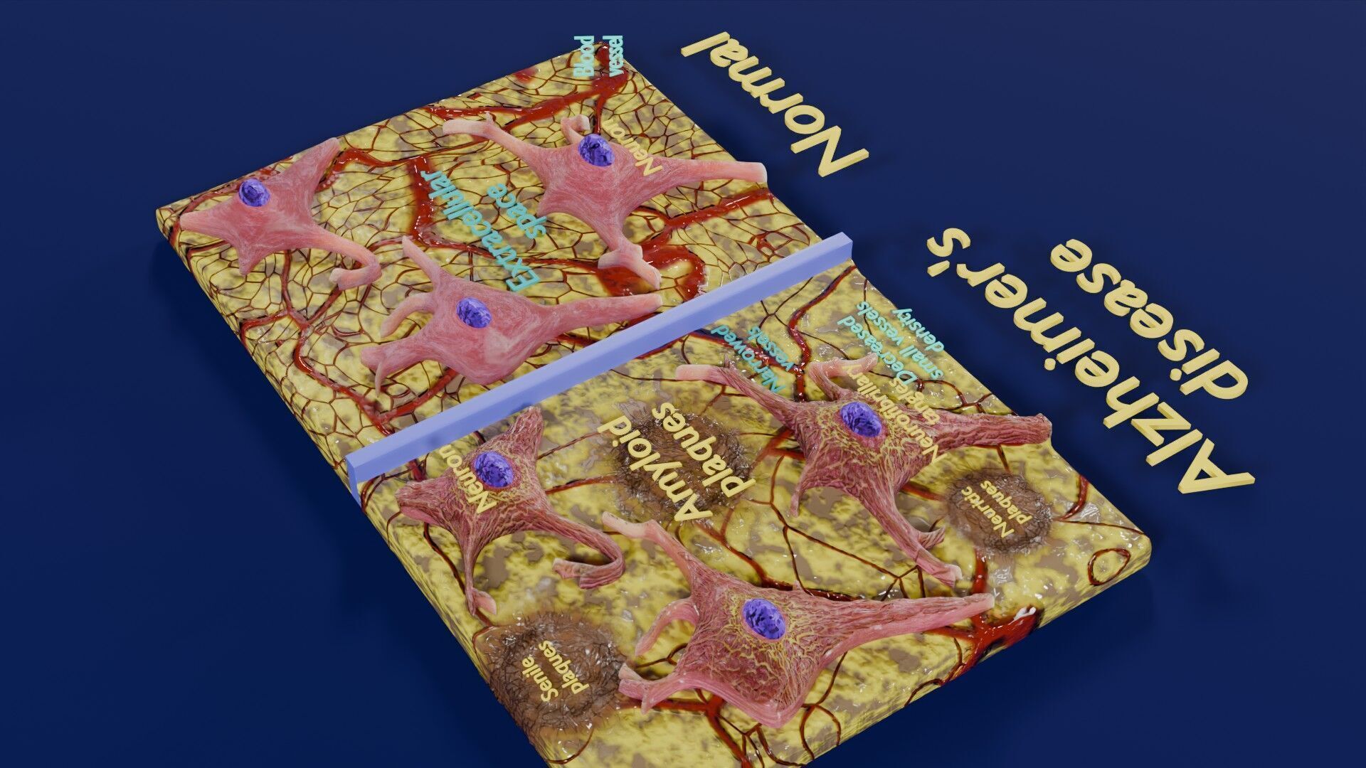 Alzheimer disease microscopy changes brain Low-poly 3D model_33