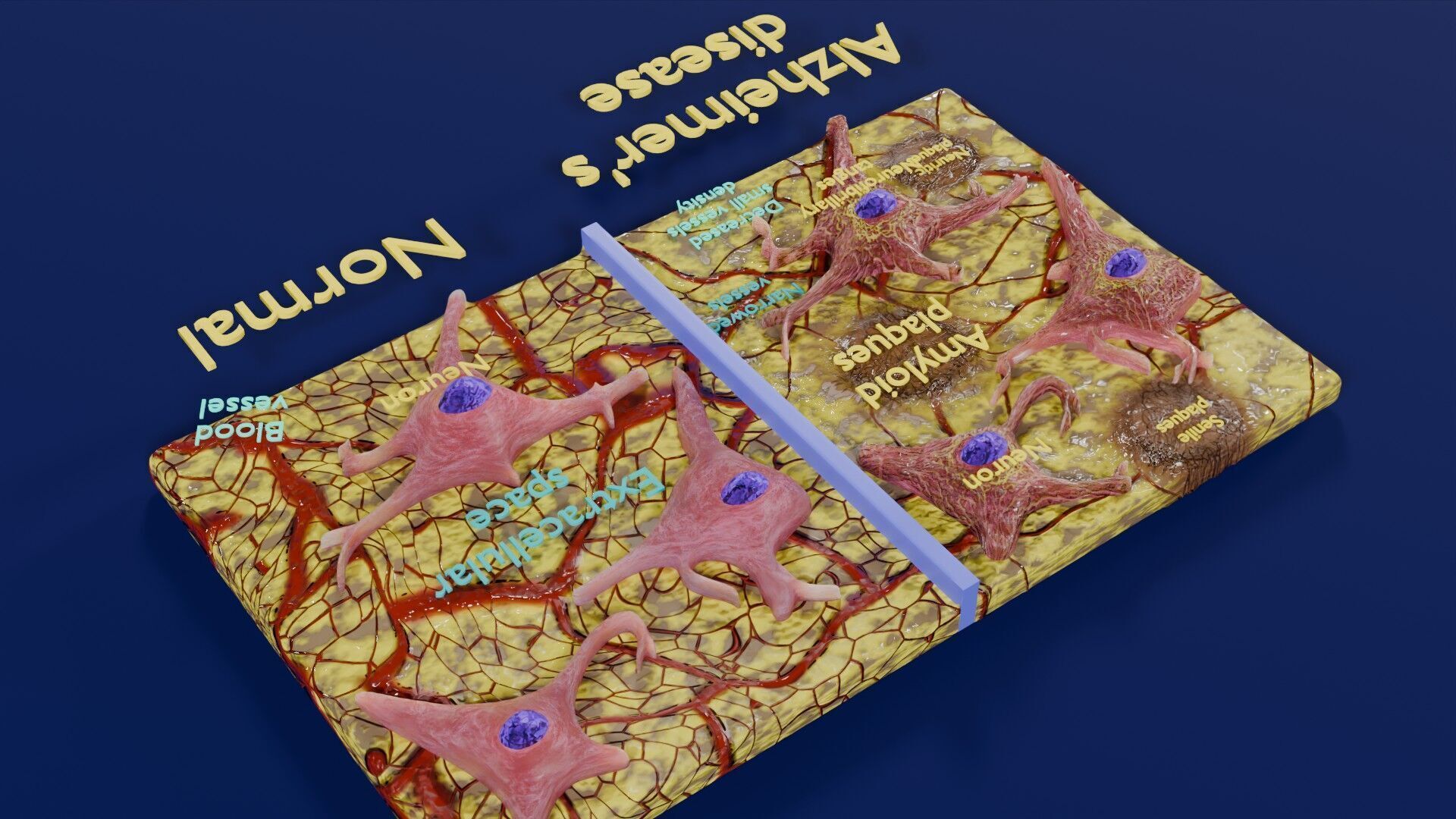 Alzheimer disease microscopy changes brain Low-poly 3D model_42