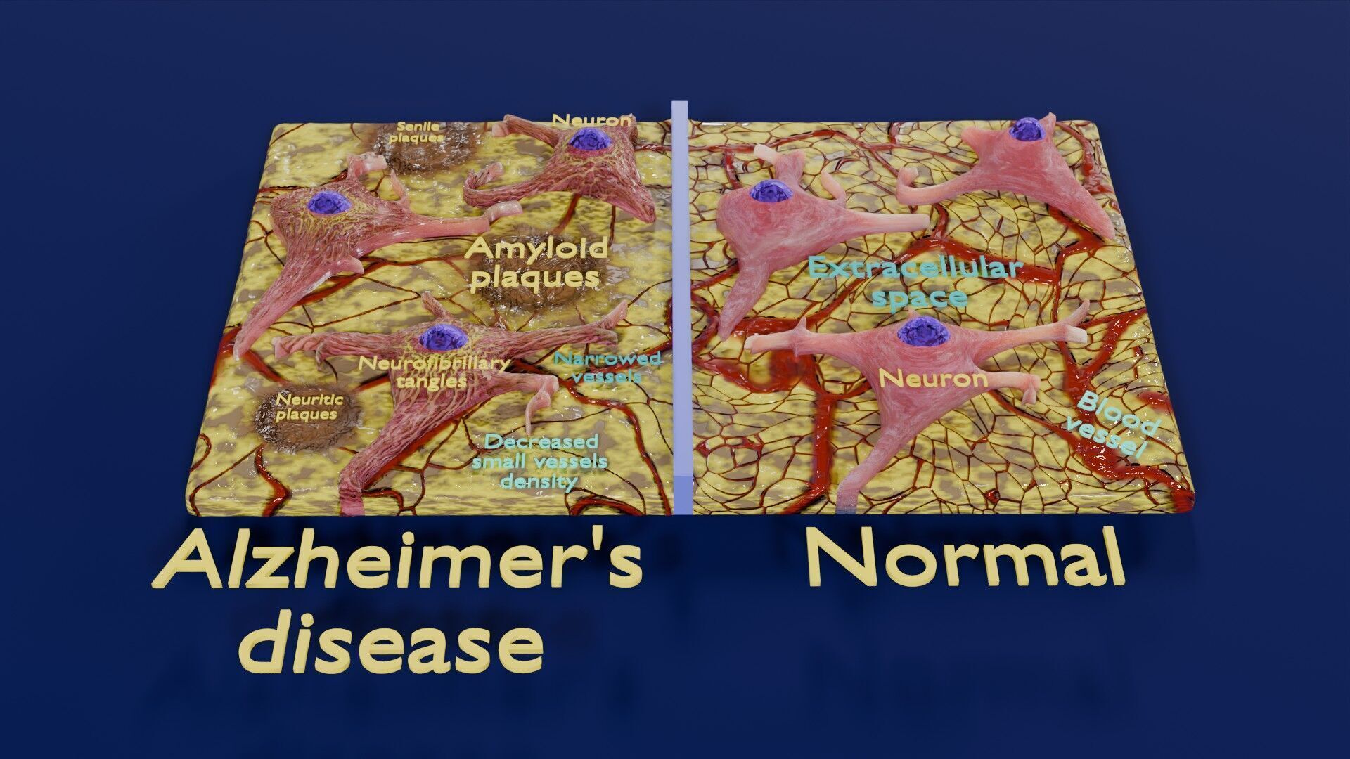 Alzheimer disease microscopy changes brain Low-poly 3D model_56
