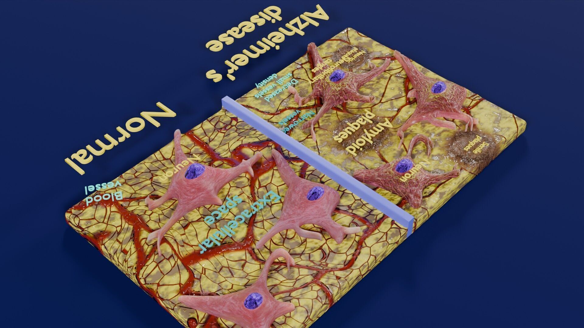 Alzheimer disease microscopy changes brain Low-poly 3D model_43