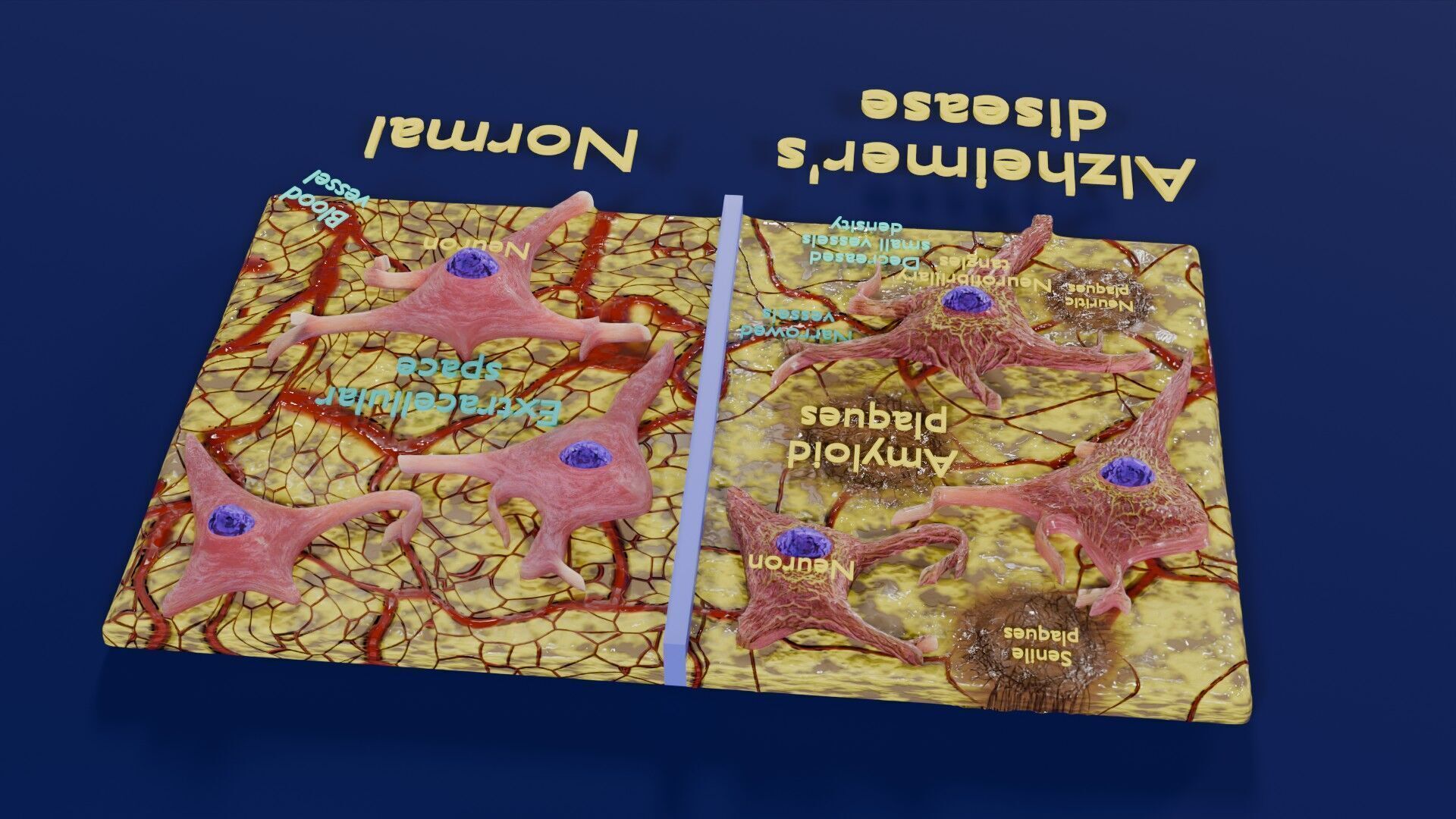 Alzheimer disease microscopy changes brain Low-poly 3D model_38