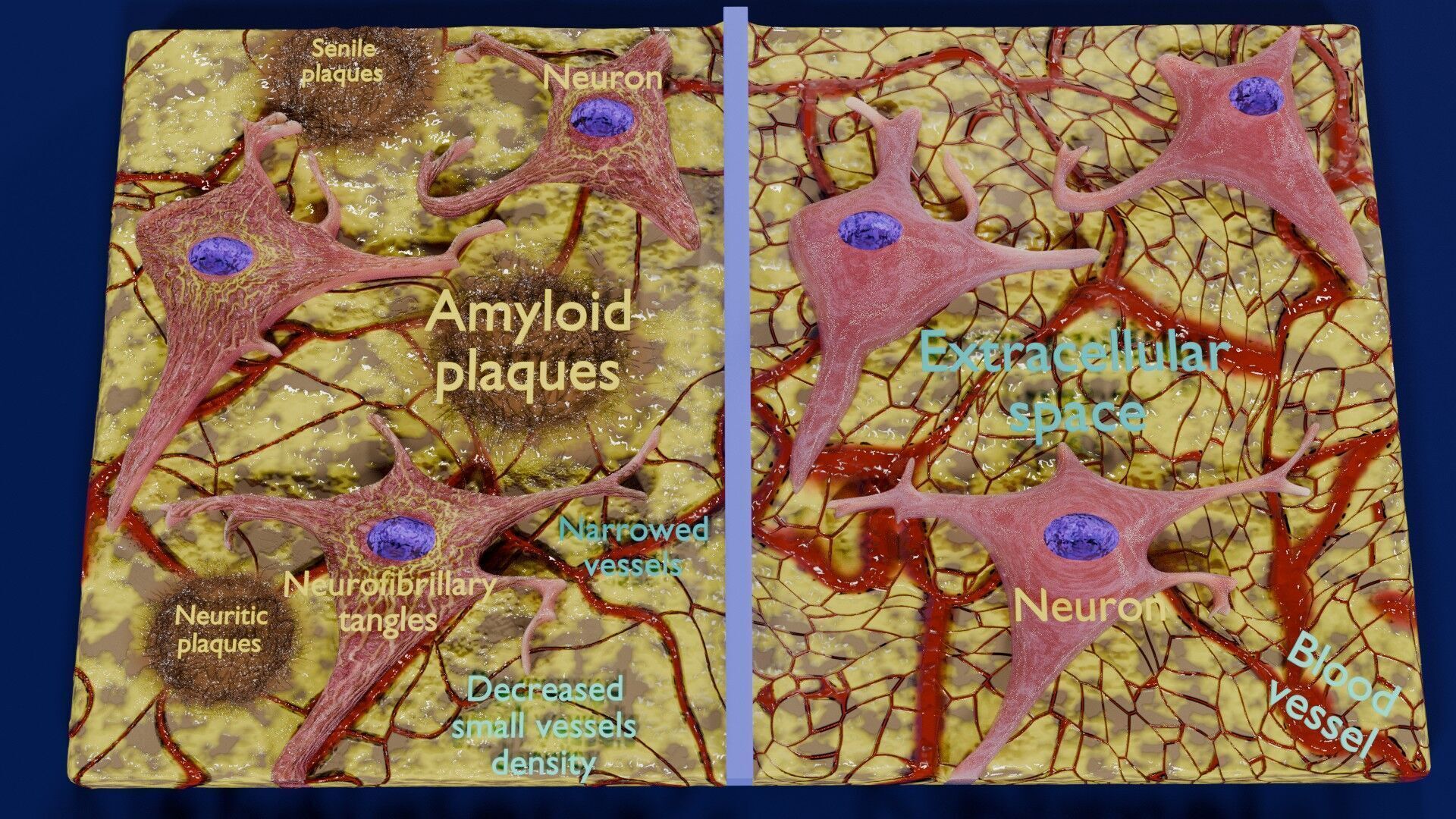 Alzheimer disease microscopy changes brain Low-poly 3D model_3