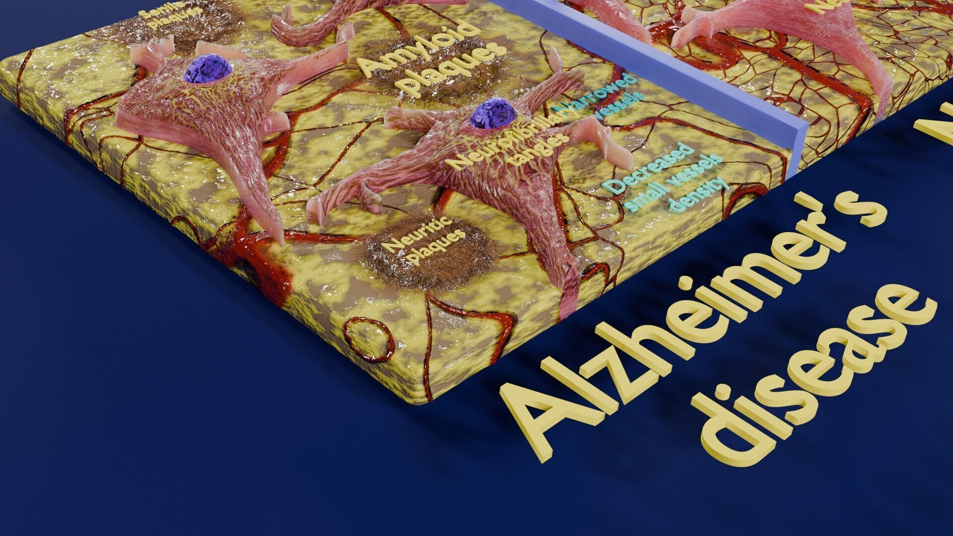 Alzheimer disease microscopy changes brain Low-poly 3D model_15