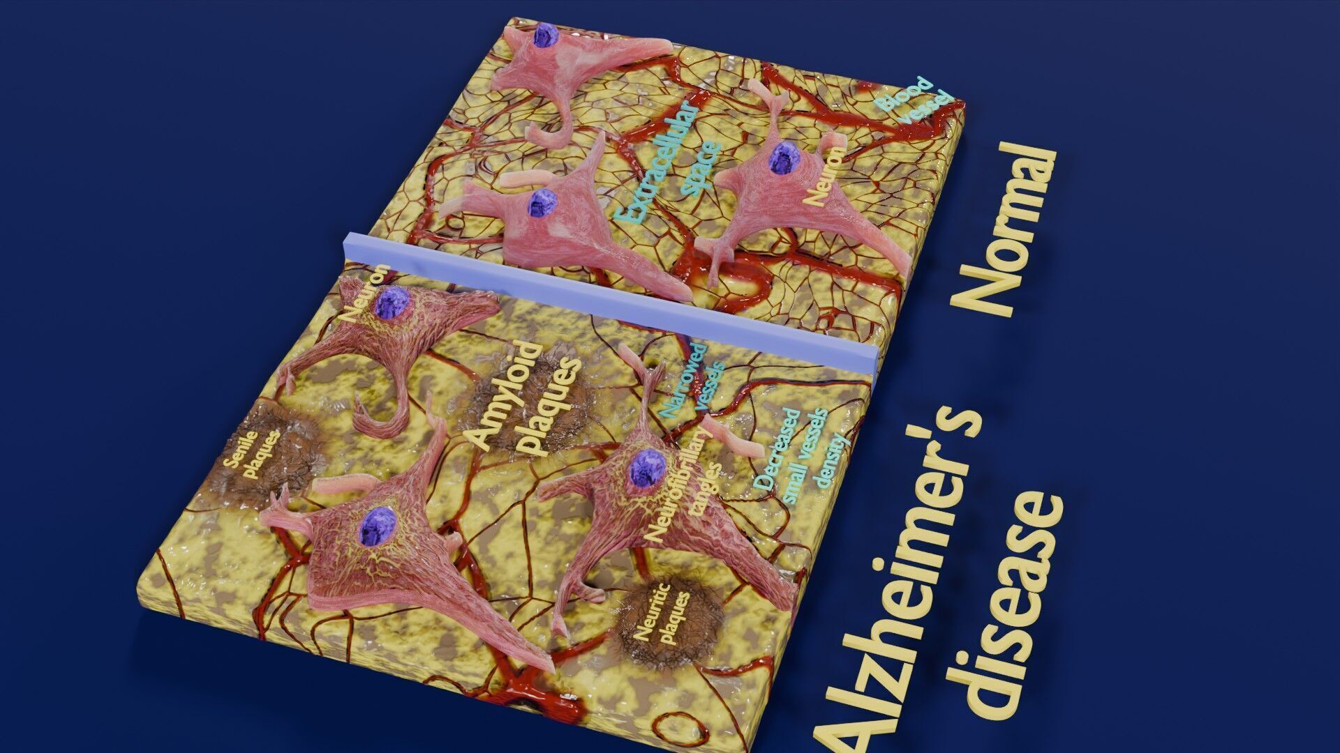 Alzheimer disease microscopy changes brain Low-poly 3D model_28
