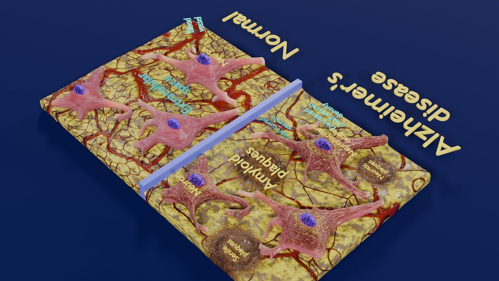 Alzheimer disease microscopy changes brain Low-poly 3D model_34