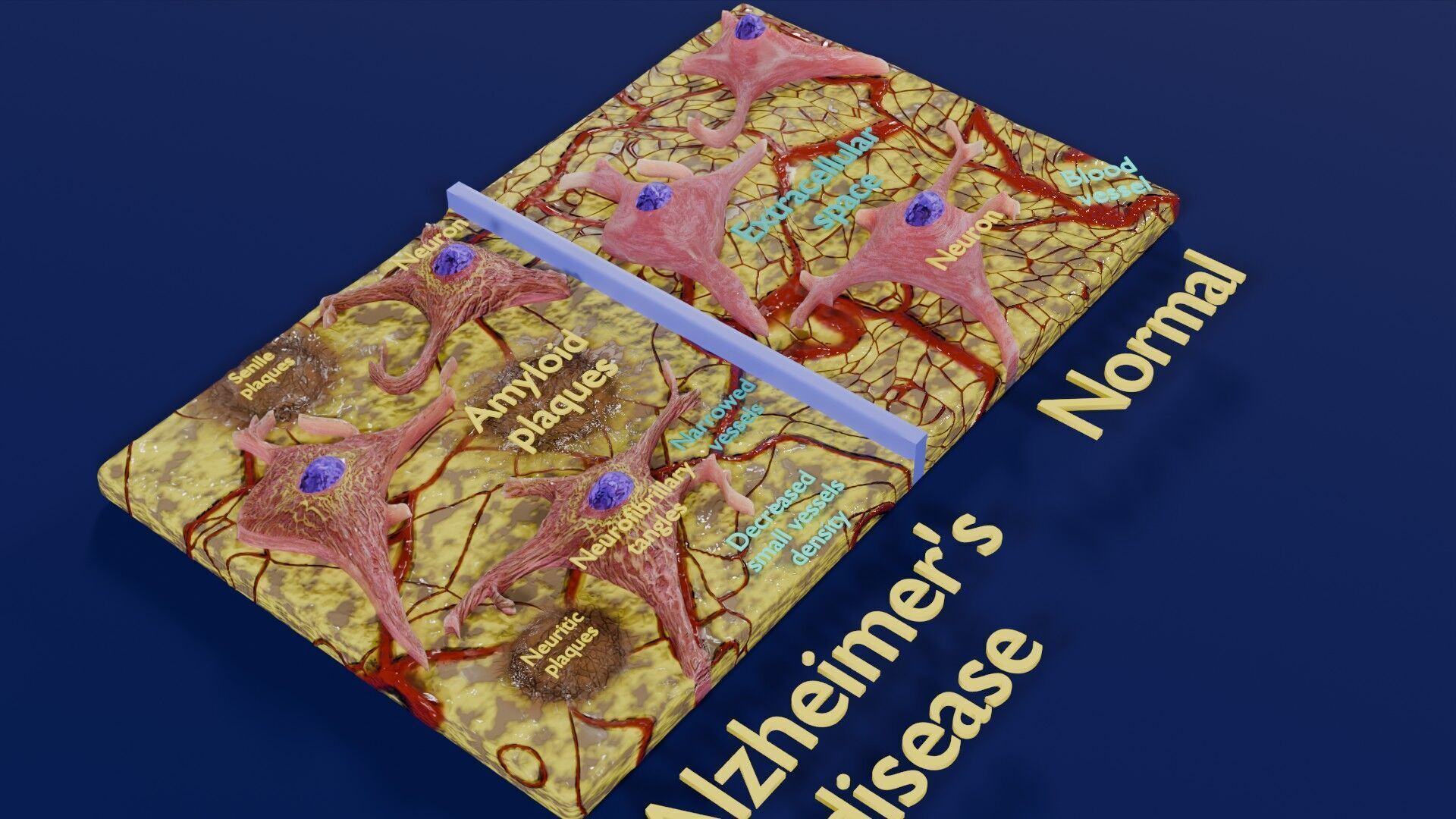 Alzheimer disease microscopy changes brain Low-poly 3D model_26
