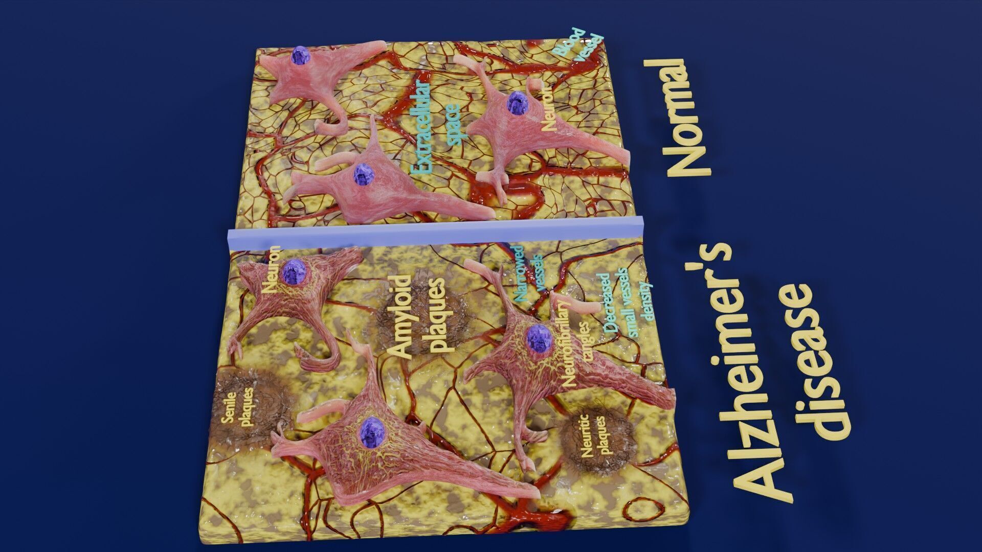 Alzheimer disease microscopy changes brain Low-poly 3D model_30