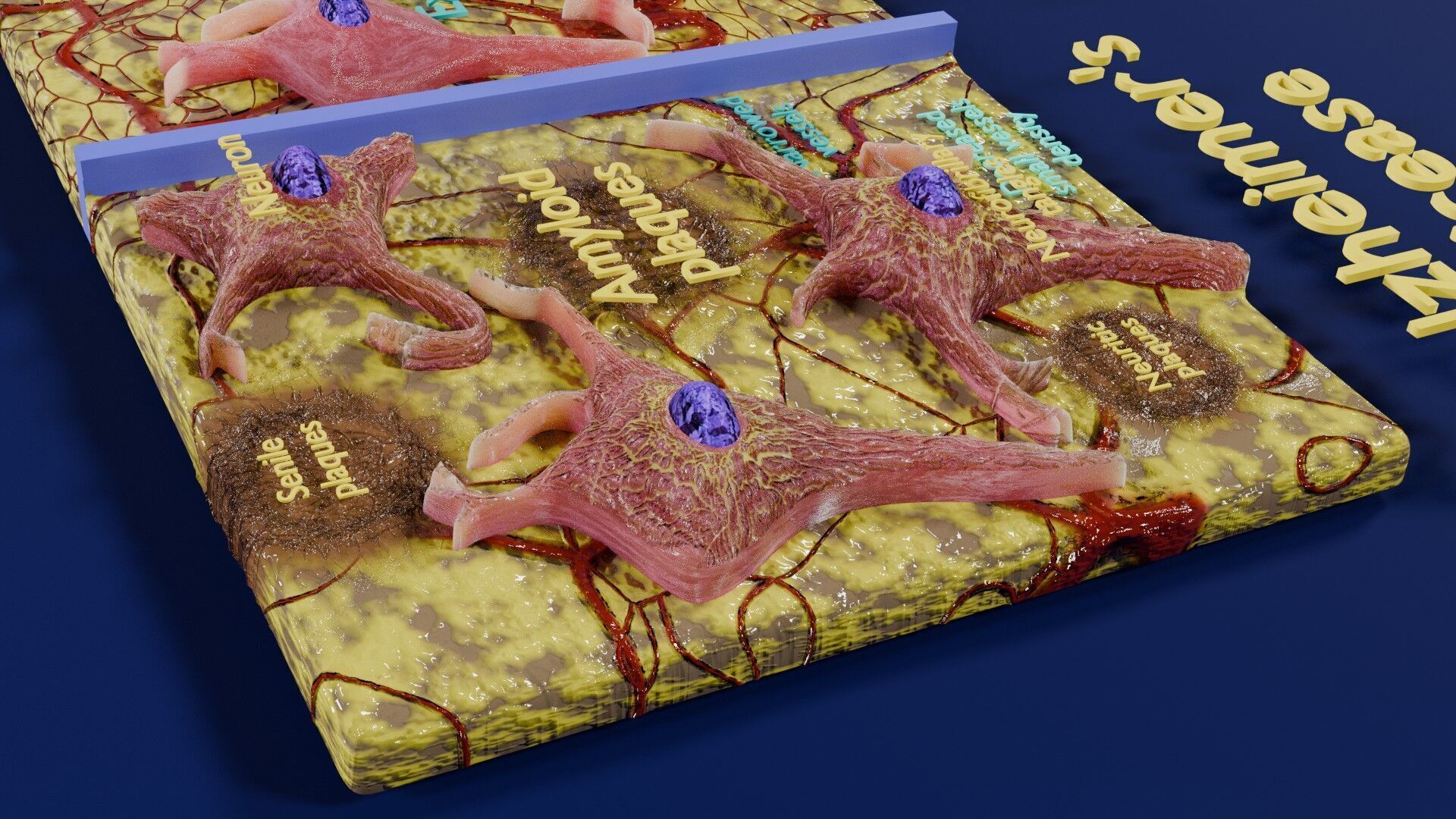 Alzheimer disease microscopy changes brain Low-poly 3D model_12