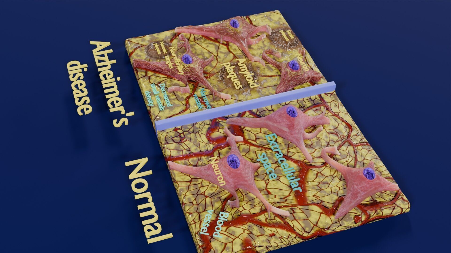 Alzheimer disease microscopy changes brain Low-poly 3D model_49