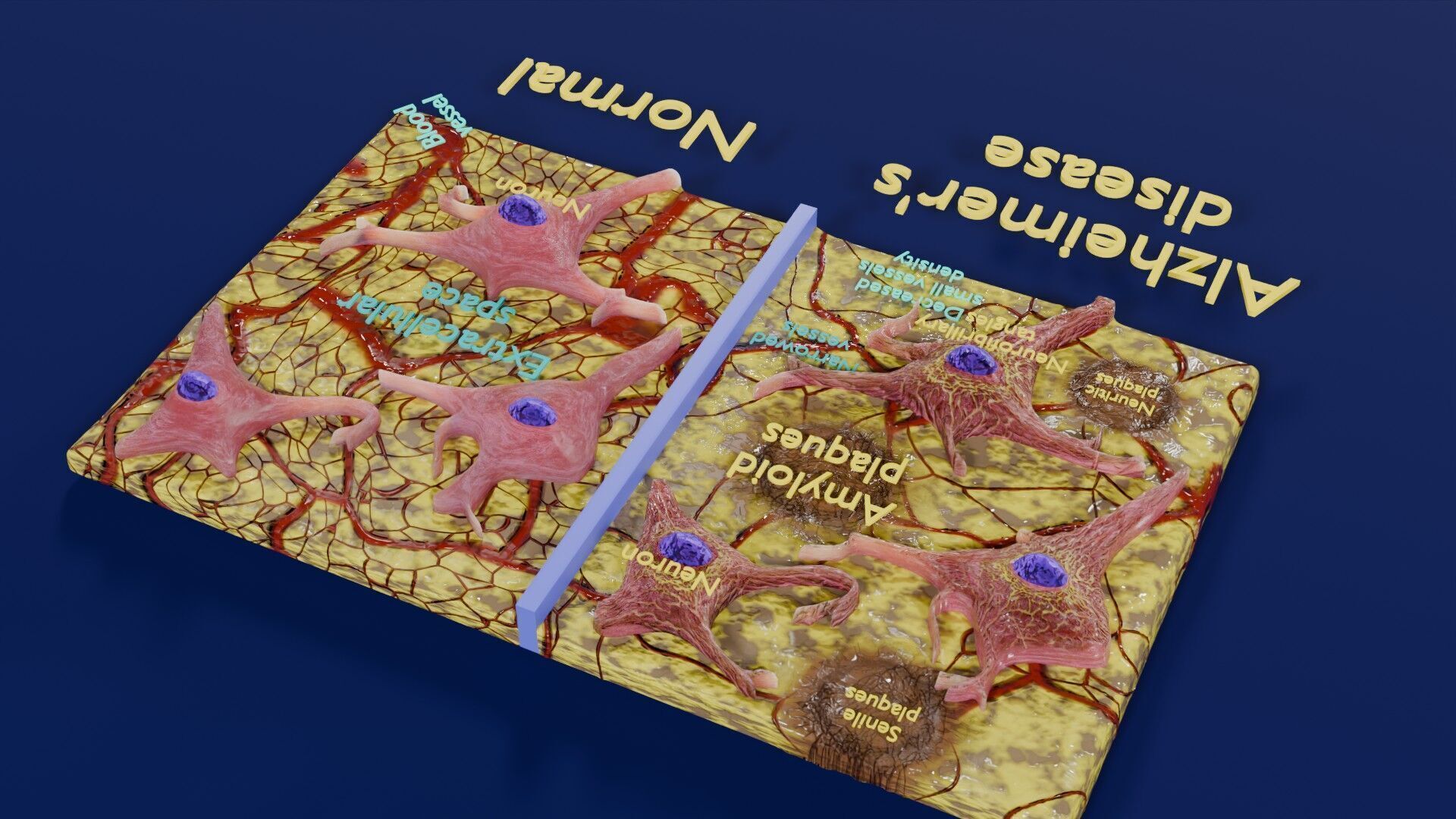 Alzheimer disease microscopy changes brain Low-poly 3D model_36