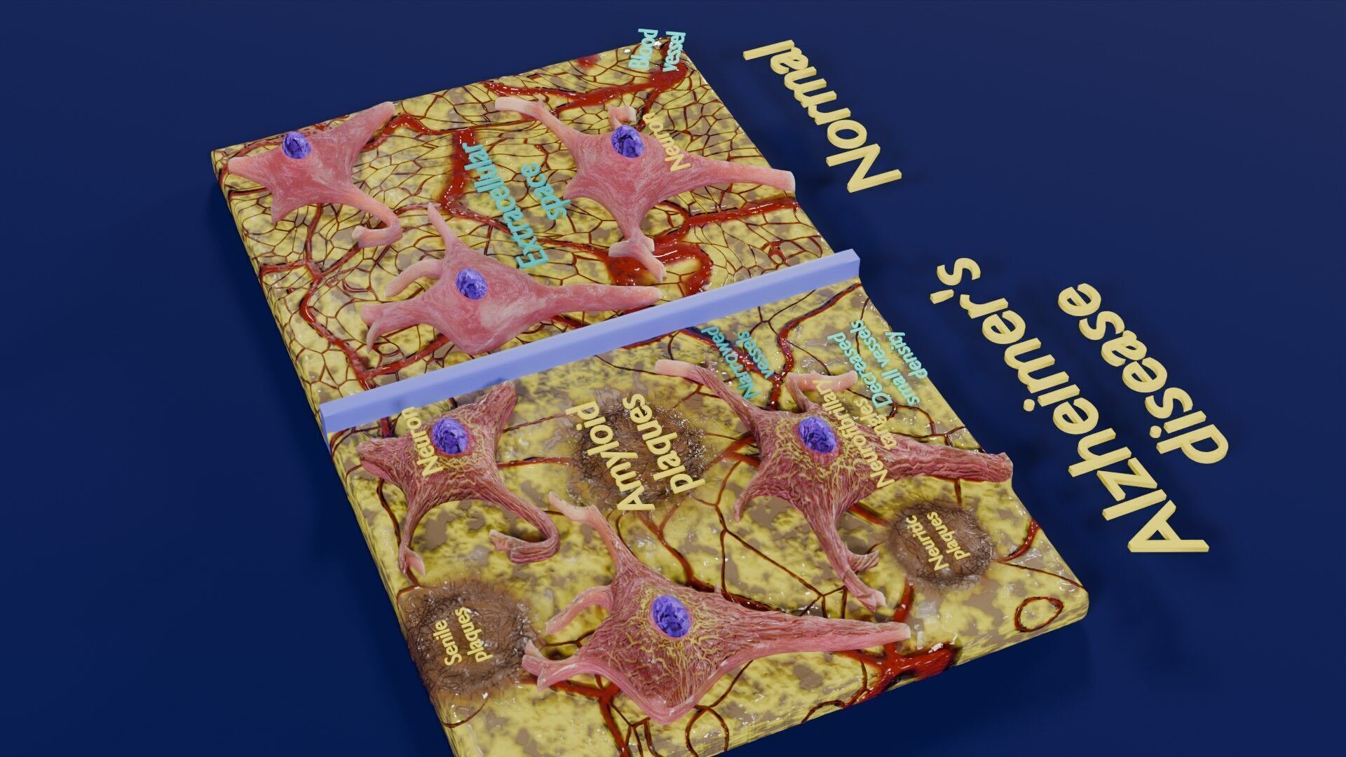 Alzheimer disease microscopy changes brain Low-poly 3D model_32