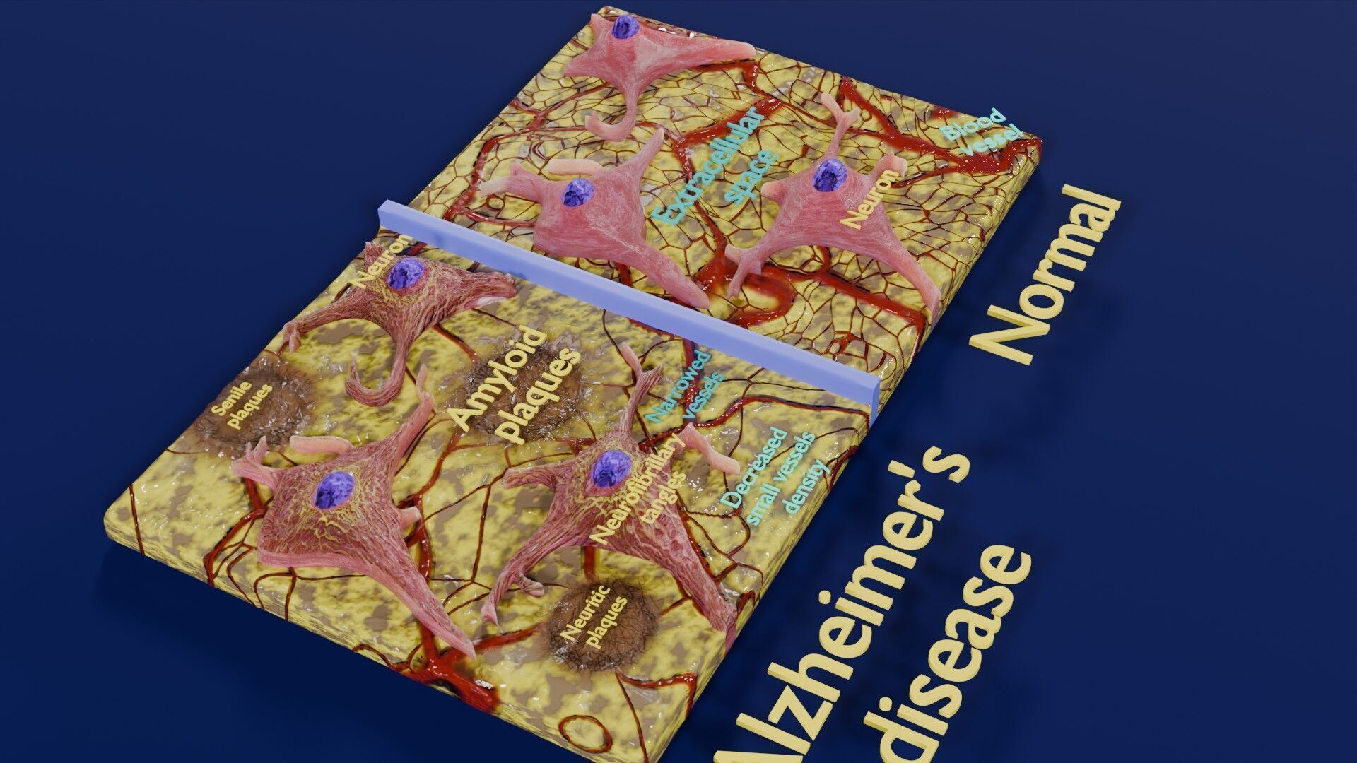 Alzheimer disease microscopy changes brain Low-poly 3D model_27