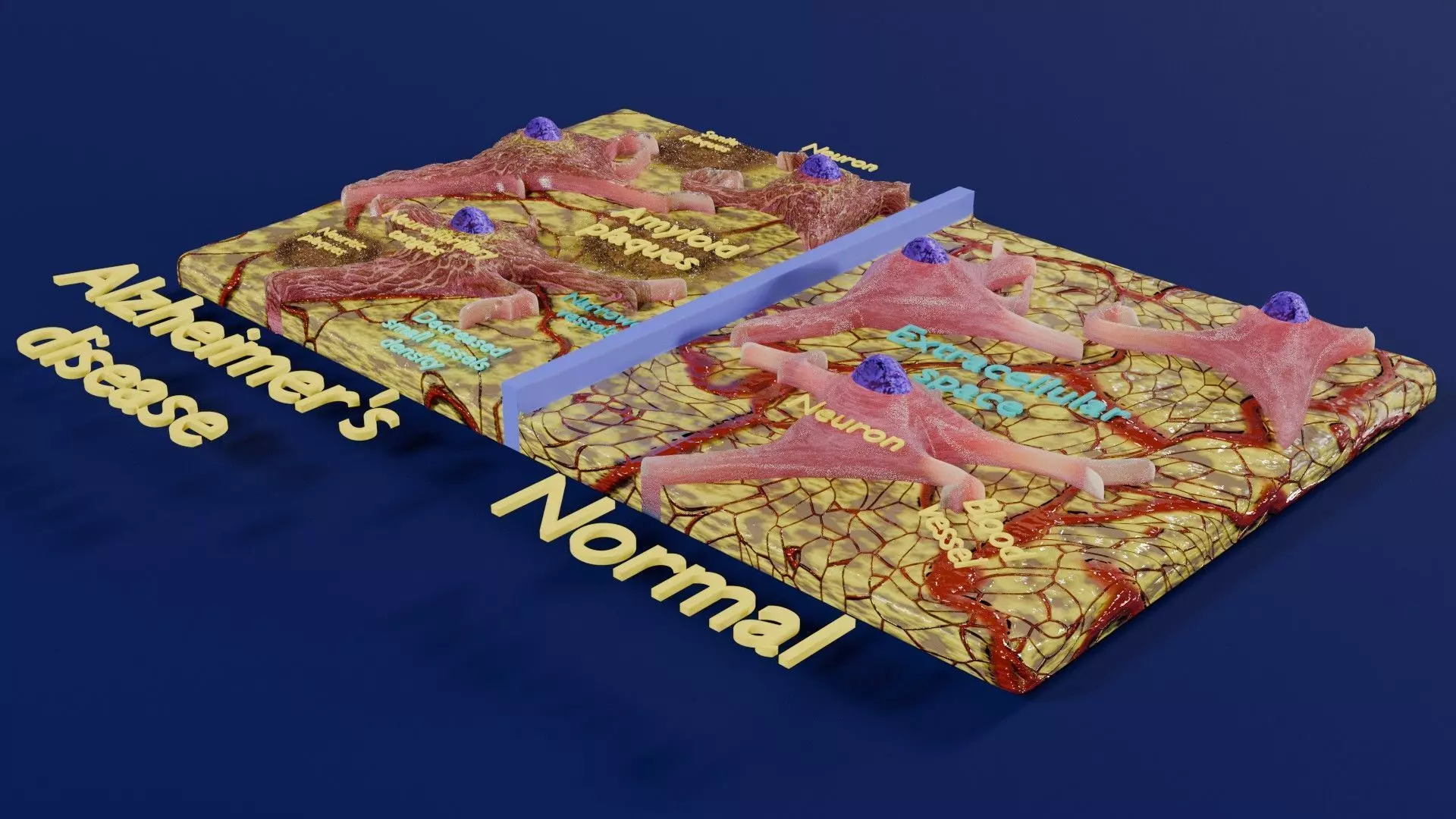Alzheimer disease microscopy changes brain Low-poly 3D model_0