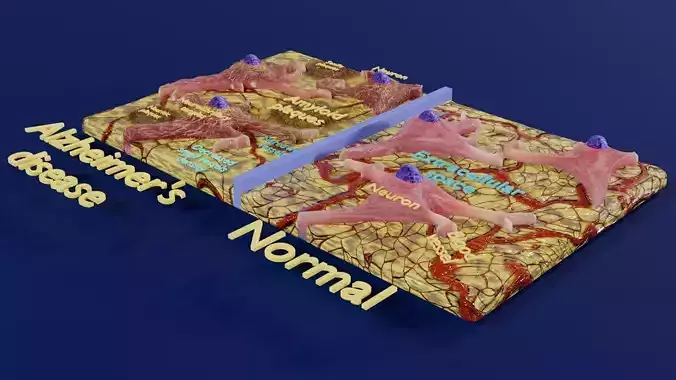 Alzheimer disease microscopy changes brain Low-poly 3D model