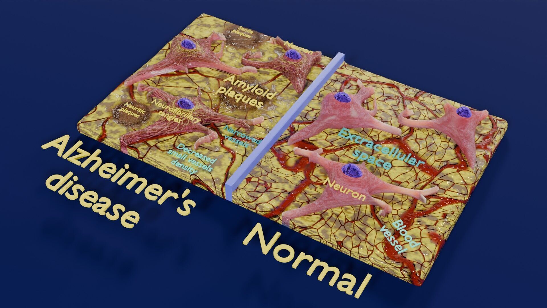 Alzheimer disease microscopy changes brain Low-poly 3D model_53