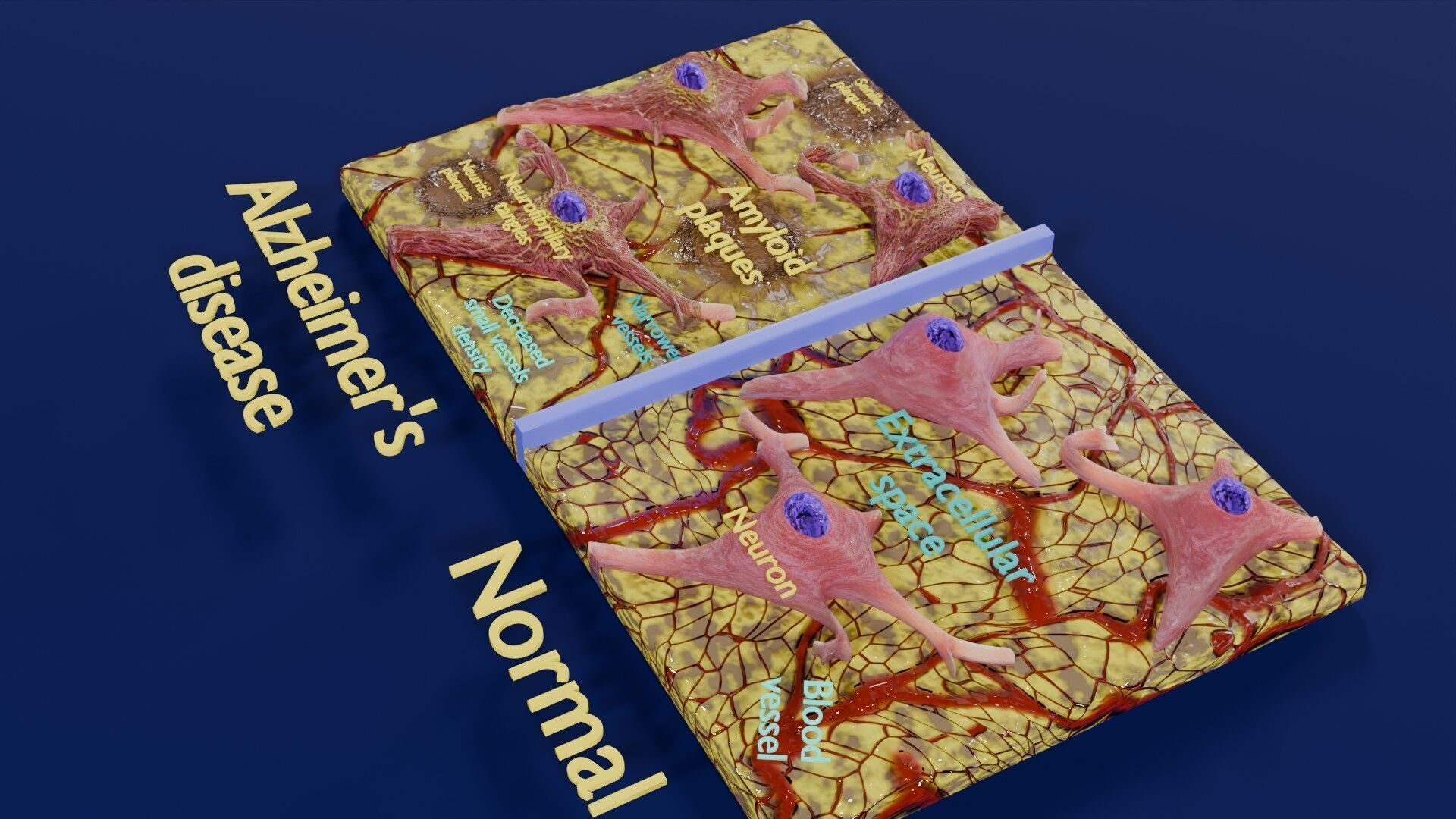 Alzheimer disease microscopy changes brain Low-poly 3D model_50