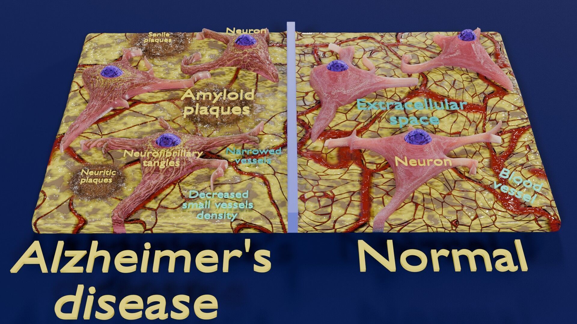 Alzheimer disease microscopy changes brain Low-poly 3D model_2