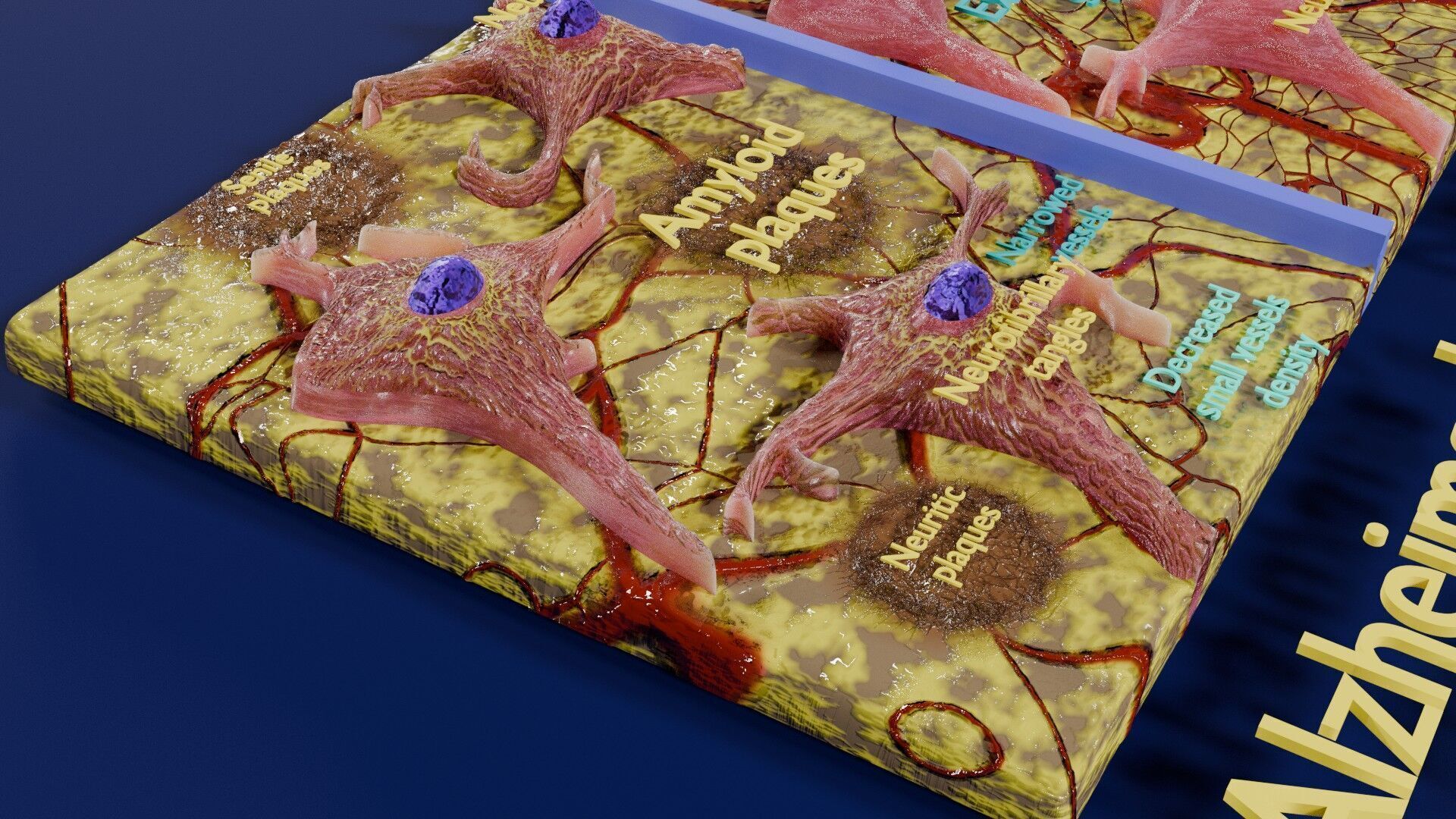 Alzheimer disease microscopy changes brain Low-poly 3D model_14