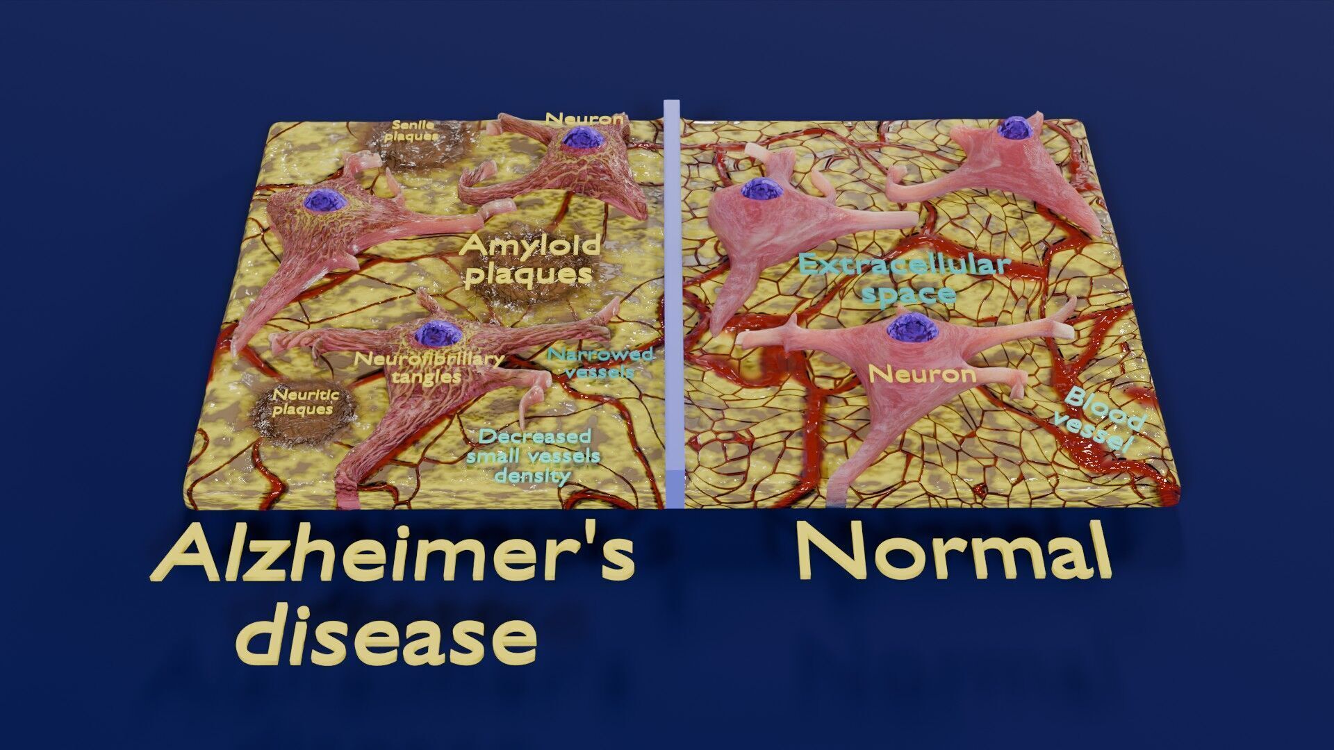 Alzheimer disease microscopy changes brain Low-poly 3D model_21