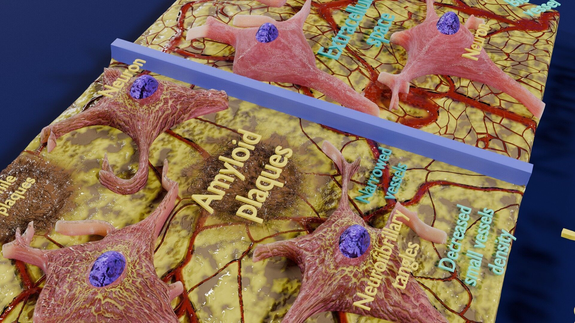 Alzheimer disease microscopy changes brain Low-poly 3D model_18