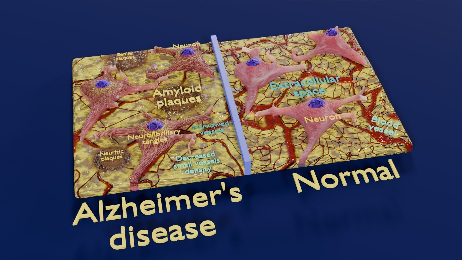 Alzheimer disease microscopy changes brain Low-poly 3D model_22