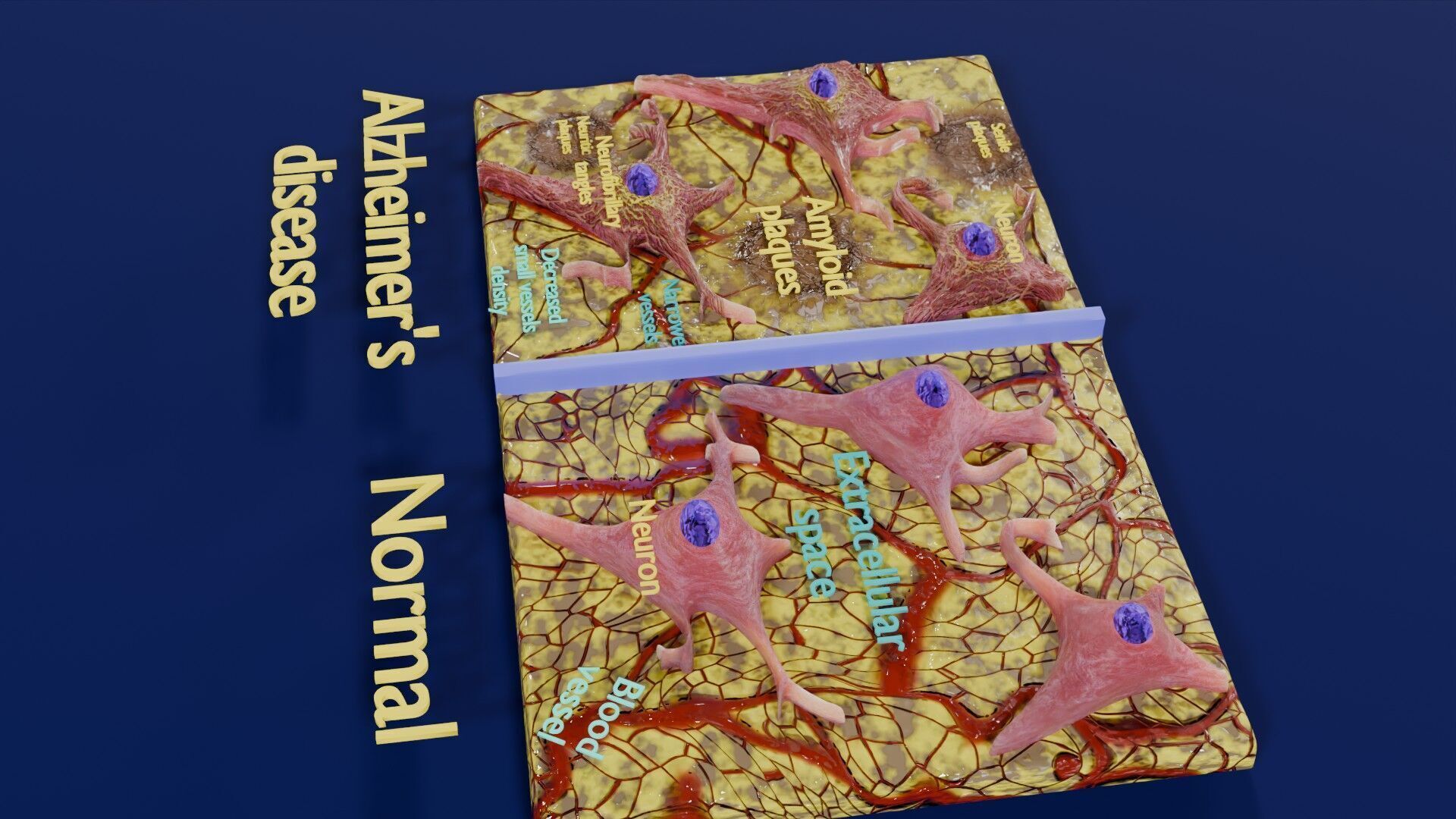 Alzheimer disease microscopy changes brain Low-poly 3D model_48